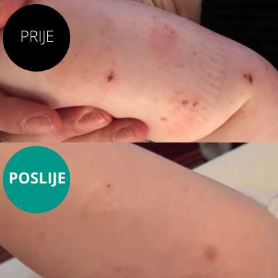 Start paket kod atopijskog dermatitisa