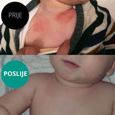Emulzija za njegu vrlo suhe kože sklone atopiji