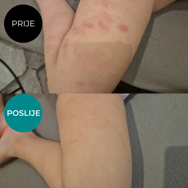 Emulzija za njegu vrlo suhe kože sklone atopiji