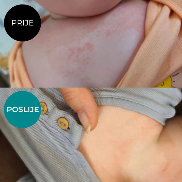 Balzam AKUT za njegu vrlo suhe kože sklone atopiji